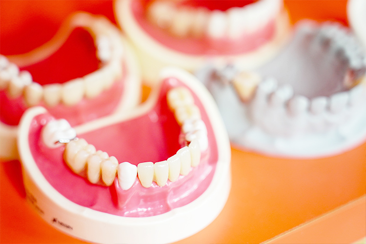 入れ歯（義歯）の種類について